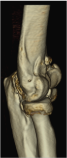 elbow osteoarthritis